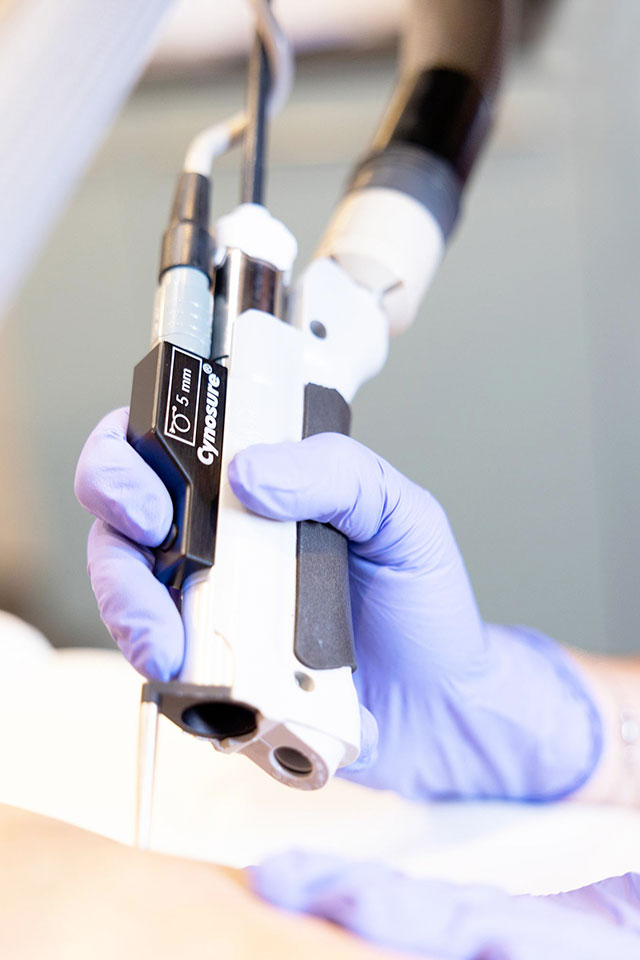 Technologie laser médicale Skinela – précision et sécurité à Tours & Châtellerault Main gantée tenant un appareil laser Cynosure lors d’une séance d’épilation laser médicale à la Clinique Skinela à Tours